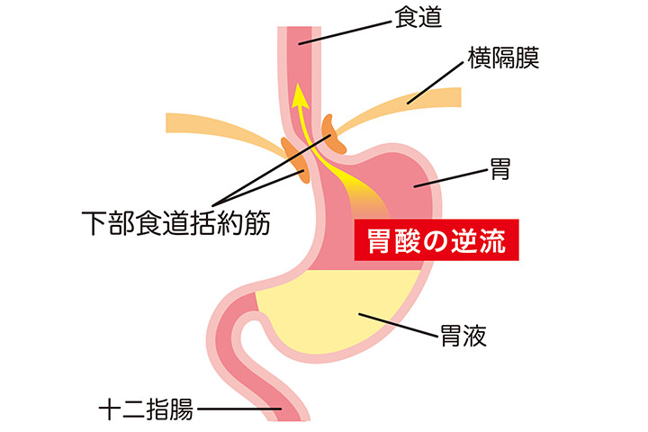 逆流性食道炎