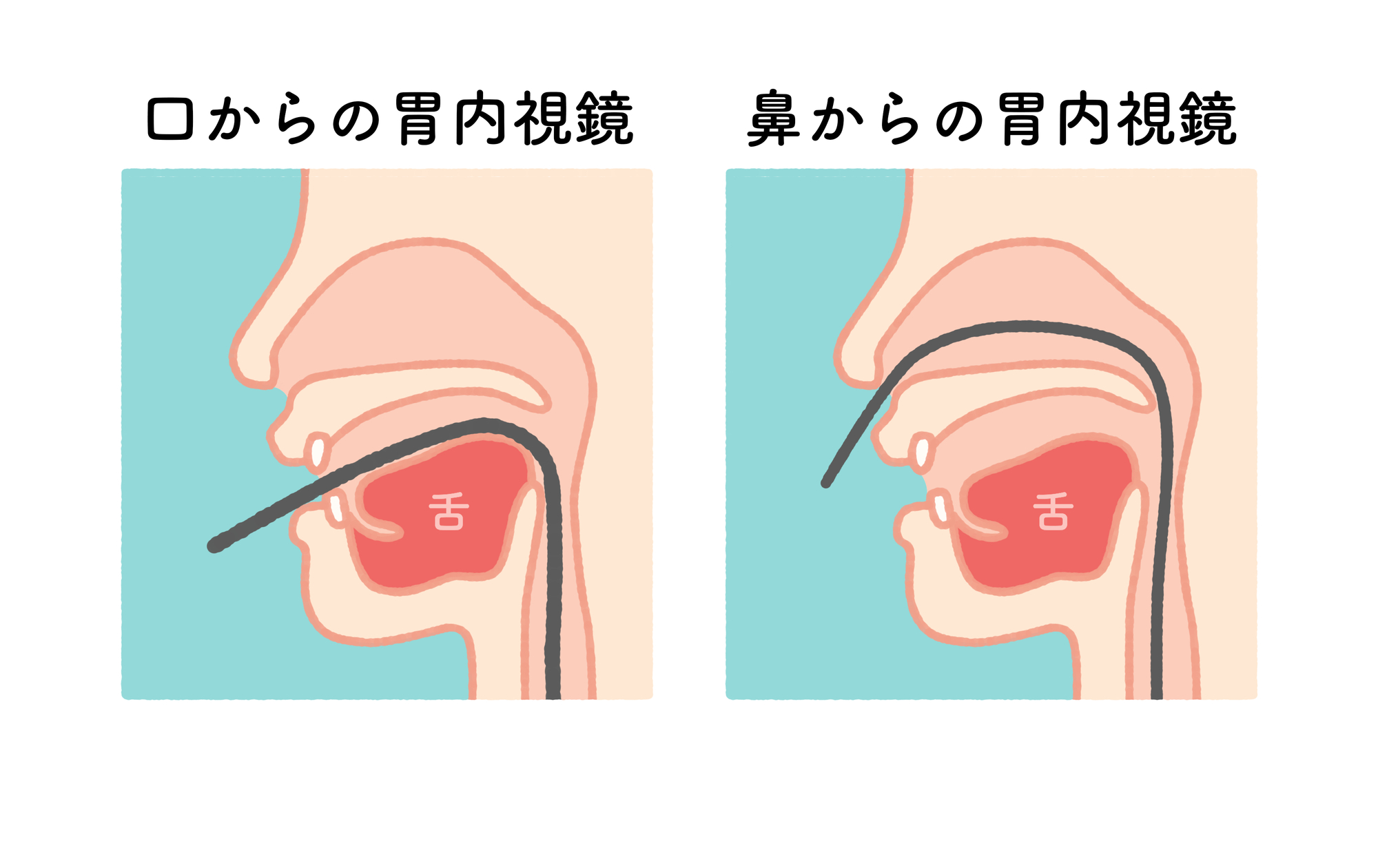 鼻から胃カメラ